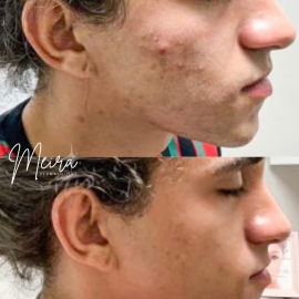 Stop Covering Up Acne — Start Treating It