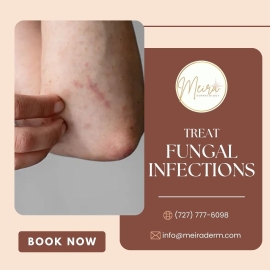 Don’t Ignore That Itch: Could It Be a Fungal Infection?