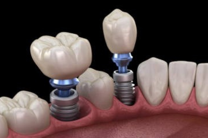 Implant-Restoration-400x241