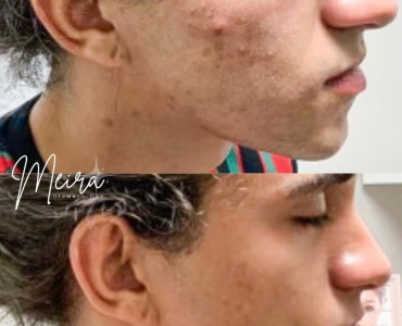 Stop Covering Up Acne — Start Treating It
