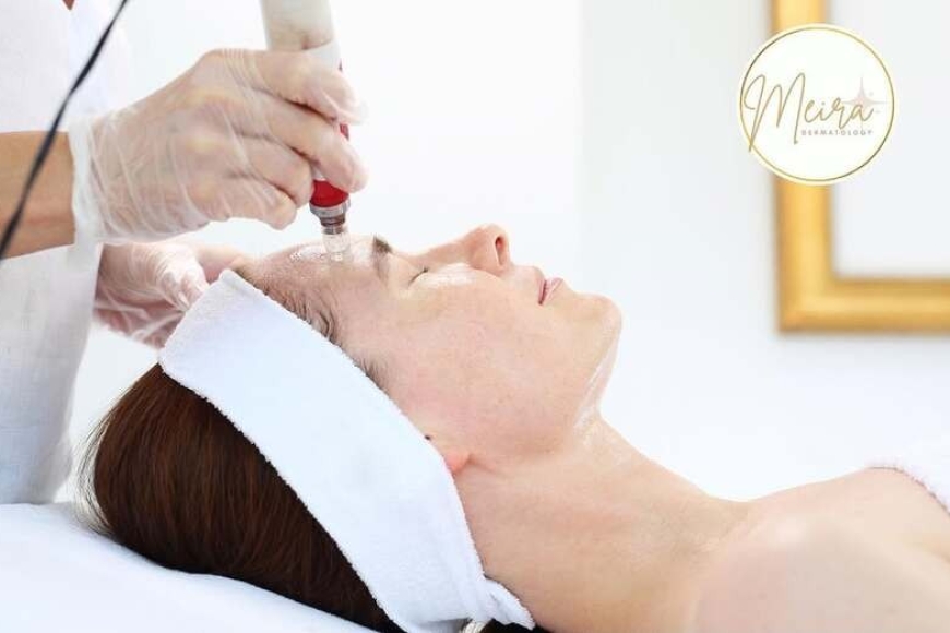 Give the gift of microneedling